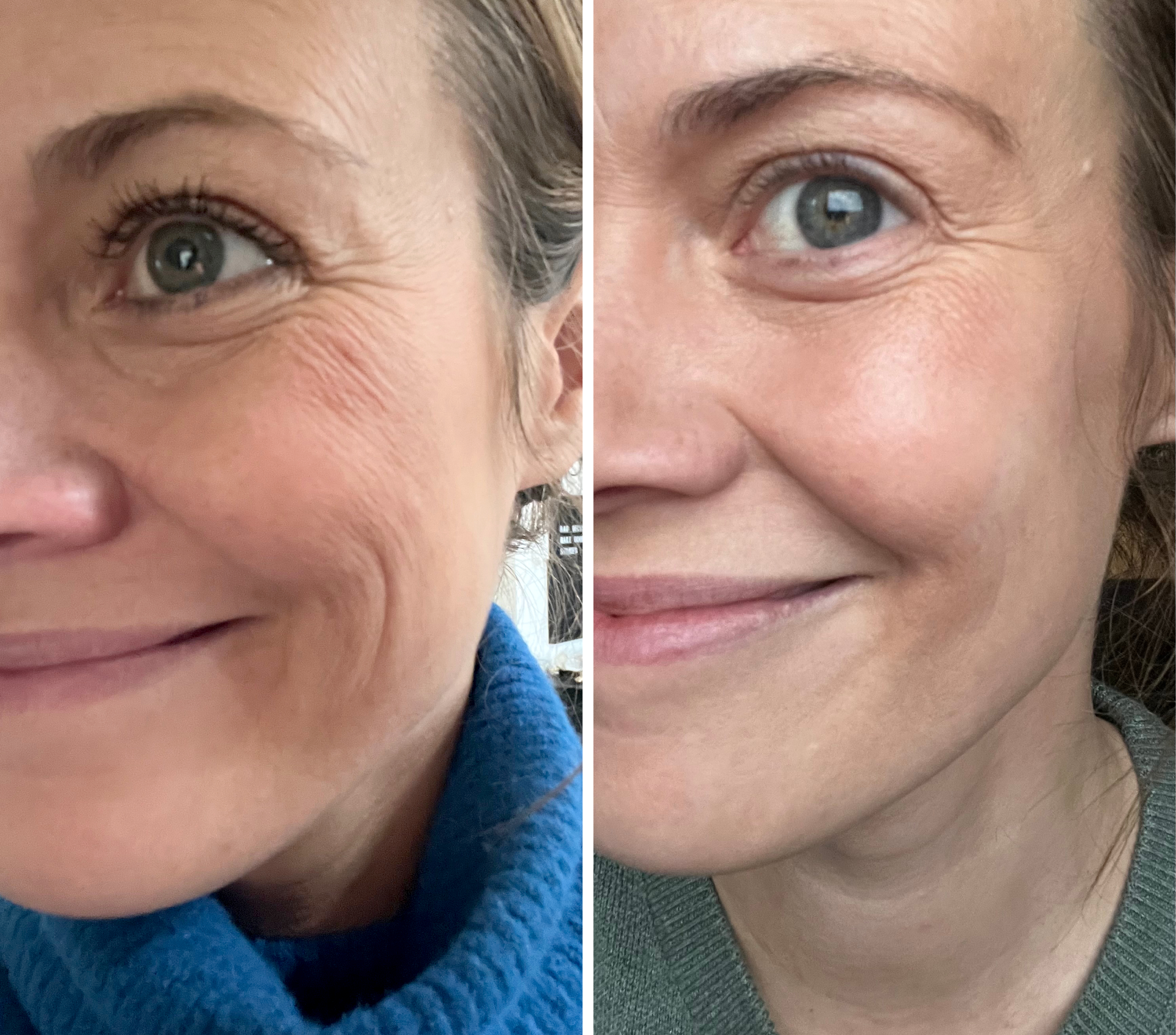 F&ouml;re&Efter2 (2).jpg